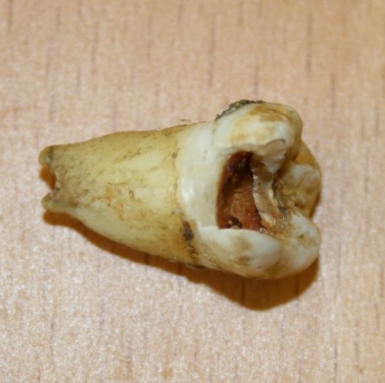 Savulaik Džonam Lenonam izrautais zobs 2011. gadā tika izsolīts 31 000 dolāriem.