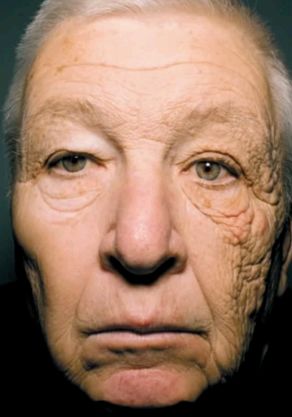 Šis 66 gadus vecais kungs 28 savas dzīves gadus pavadījis braucot un strādājot automašīnā, kreiso sejas pusi pavērsis pret logu. Bildē var lieliski redzēt, ka sejas puse, kura nebija ikdienu pakļauta ilgstošai saules staru iedarbībai izskatās ievērojami labāk.