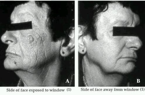 Šī sieviete 15 gadus strādāja birojā ar vienu sejas pusi pavērstu pret logu. Rezultāts – pret logu pavērstā sejas puse ir grumbām izvagota.
